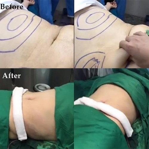 &#34;Sởn da gà&#34; nghe chuyện &#34;bóc&#34; mỡ bụng của mỹ nữ Việt - 2