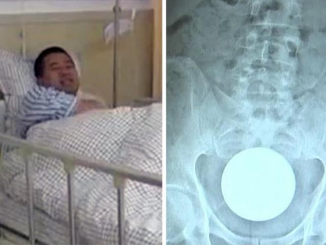 Nhét quả bóng 7cm vào hậu môn, không tài nào lấy ra được