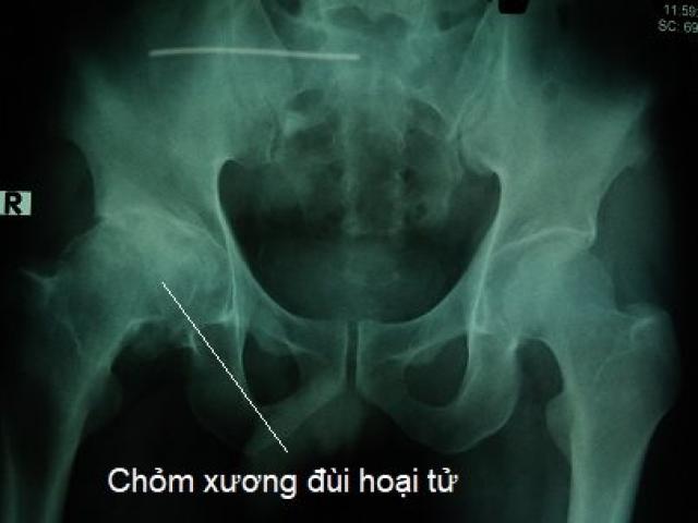 Căn bệnh đang trẻ hóa và gặp 80% ở nam giới