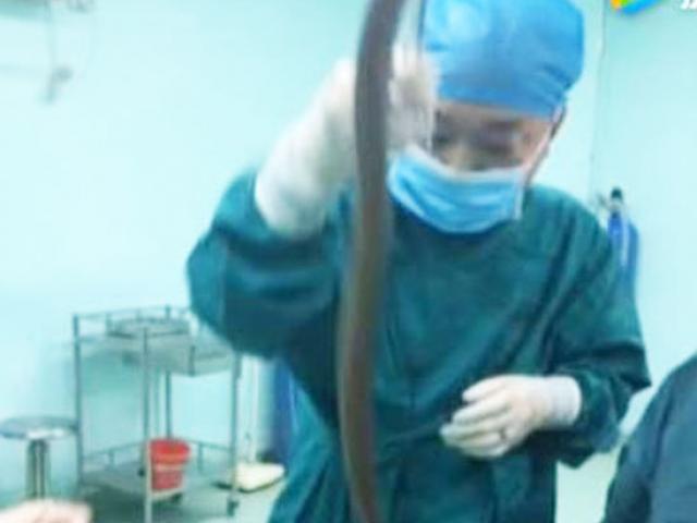 Lươn dài 50cm chui từ hậu môn vào làm tổ trong bụng người đàn ông