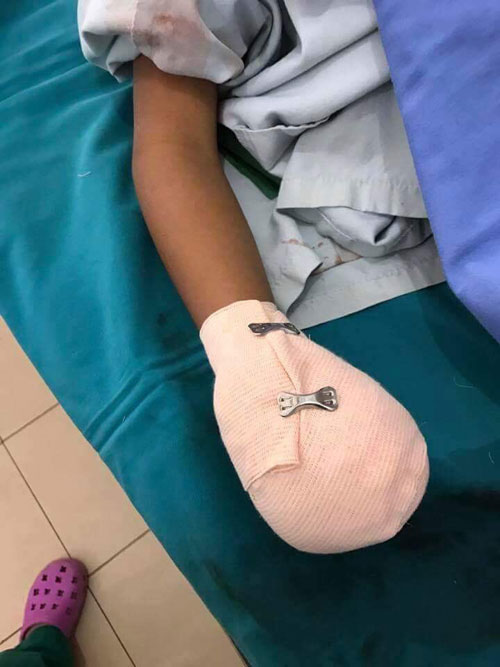 Pin dự phòng phát nổ, người đàn ông vỡ toác mu bàn tay Pin dự phòng phát nổ, người đàn ông vỡ toác mu bàn tay