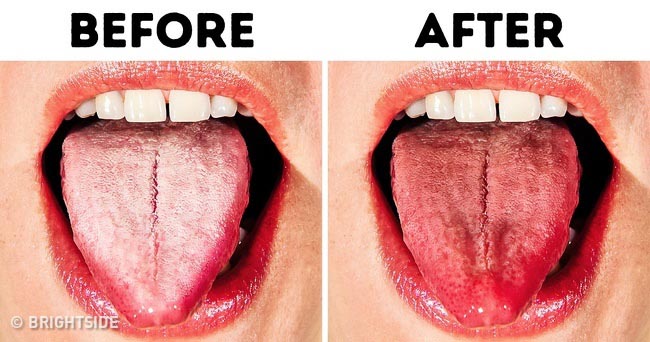 10 cách chữa bệnh lưỡi trắng đơn giản nhất ngay tại nhà - 1