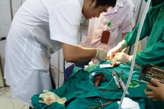 Suýt chết vì bị cá rô chui vào cổ họng - 1
