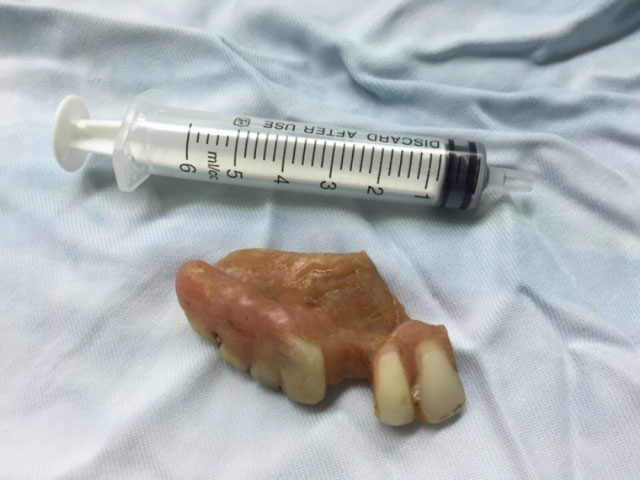 Vội ăn bún, nuốt cả hàm răng giả - 1