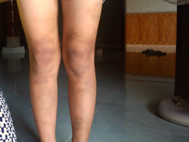 Công an vào cuộc vụ bé gái 8 tuổi bị cha đánh dã man
