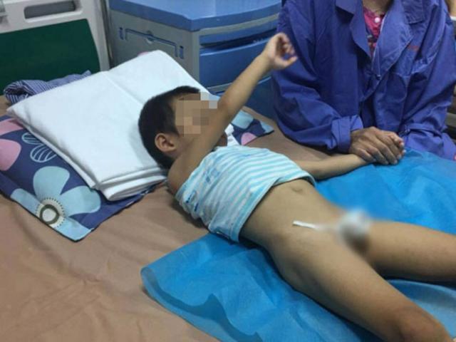 Dồn dập trẻ từ Hưng Yên đến viện khám sùi mào gà sau cắt bao quy đầu