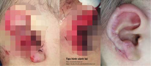 Hà Nội: Bé trai 18 tháng tuổi bị chó nhà hàng xóm cắn nát tai - 1