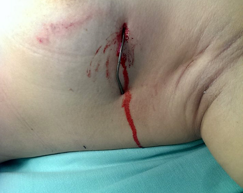 Mới nói hôm bữa,giờ có ngừoi bị