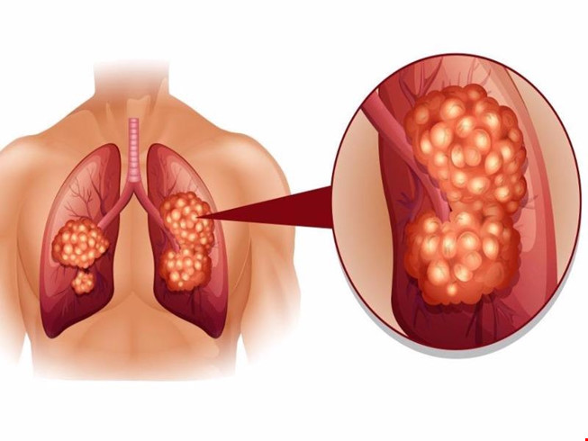 Những dấu hiệu không ngờ của bệnh ung thư phổi - 1
