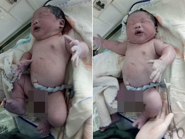 Chưa từng có ở Việt Nam: Bé trai vừa chào đời đã nặng 7,1kg Chưa từng có ở Việt Nam: Bé trai vừa chào đời đã nặng 7,1kg