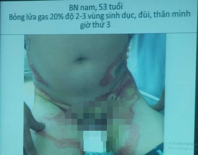 Bật lửa phát nổ trong túi quần, người đàn ông bỏng nặng Bật lửa phát nổ trong túi quần, người đàn ông bỏng nặng