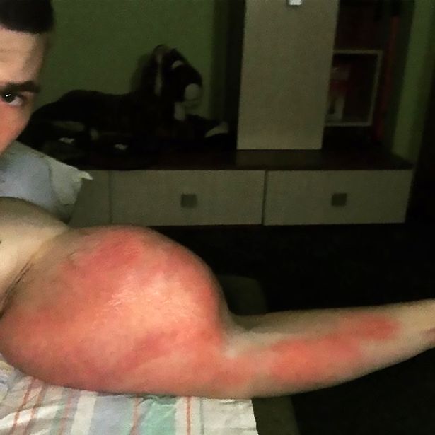 Hot boy Nga sắp mất 2 bắp tay khổng lồ vì tiêm dầu ăn, rượu vào người - 3