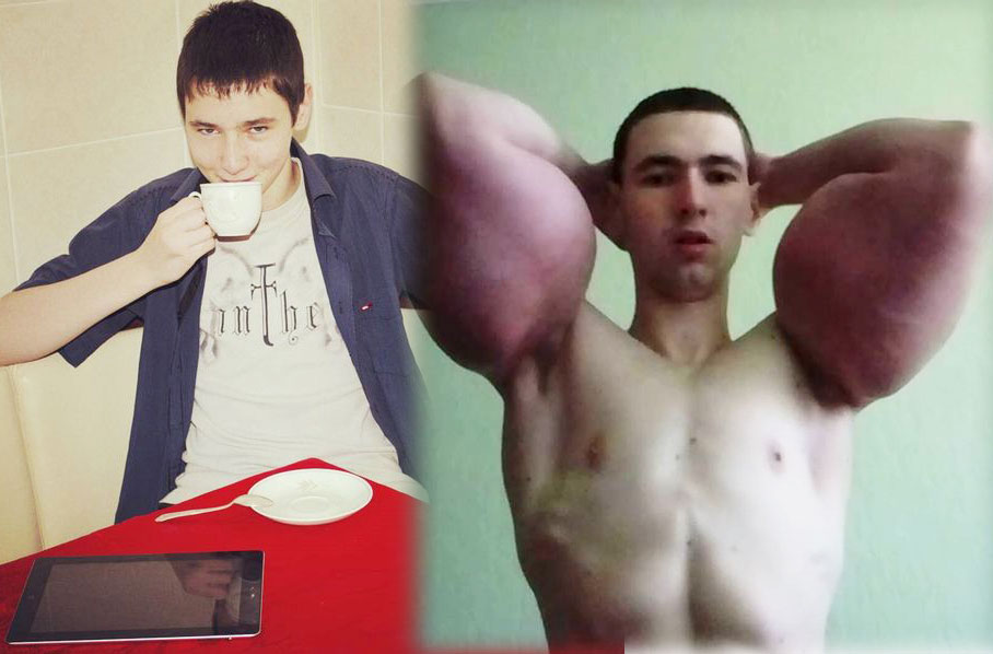 Hot boy Nga sắp mất 2 bắp tay khổng lồ vì tiêm dầu ăn, rượu vào người - 2