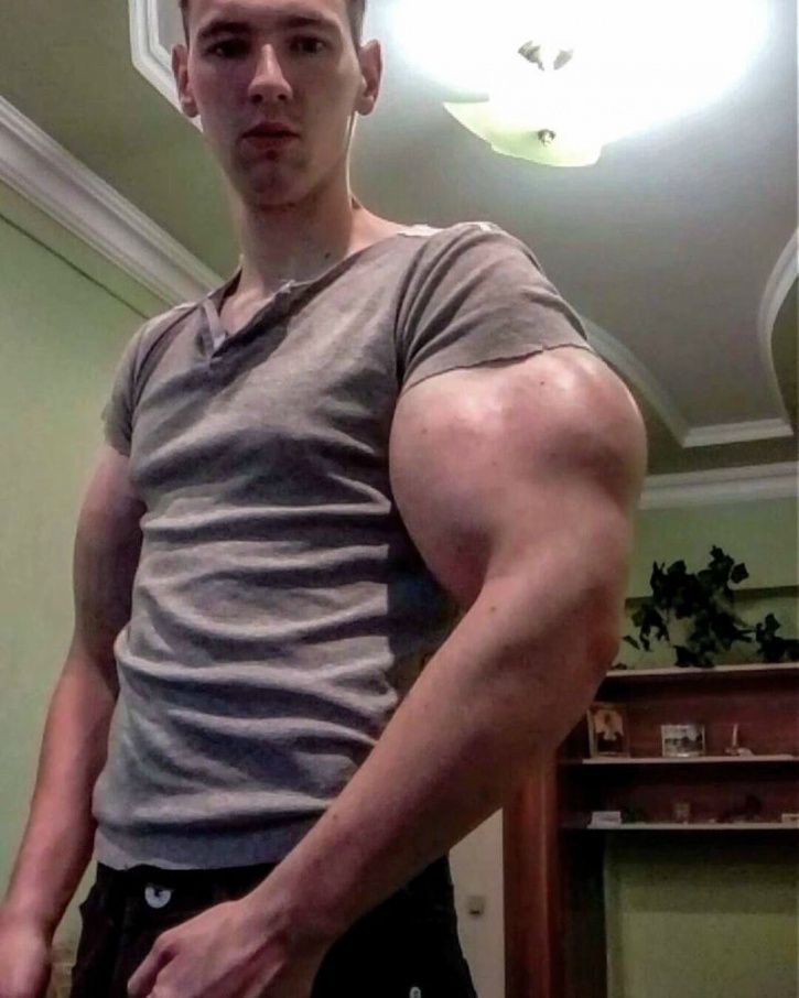 Hot boy Nga sắp mất 2 bắp tay khổng lồ vì tiêm dầu ăn, rượu vào người - 7