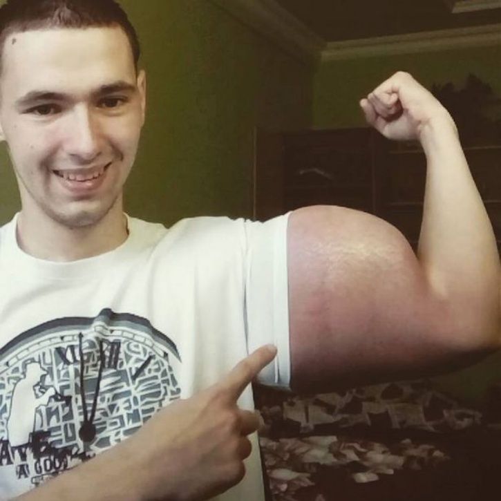 Hot boy Nga sắp mất 2 bắp tay khổng lồ vì tiêm dầu ăn, rượu vào người - 6