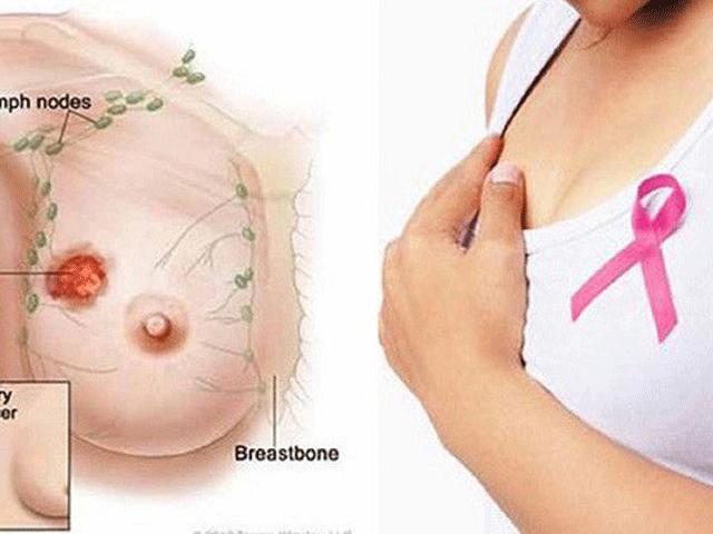 Kỳ lạ phương pháp điều trị ung thư vú bằng 1 phần cơ thể