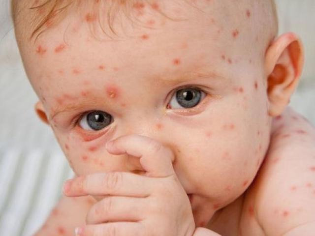 Chuyên gia hướng dẫn cách phòng ngừa sởi đơn giản, ai cũng làm được