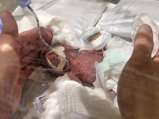 Cậu bé nhỏ nhất thế giới: 268g vẫn sống sót kỳ diệu!