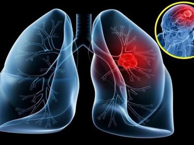 Tưởng cảm lạnh hóa ra ung thư phổi