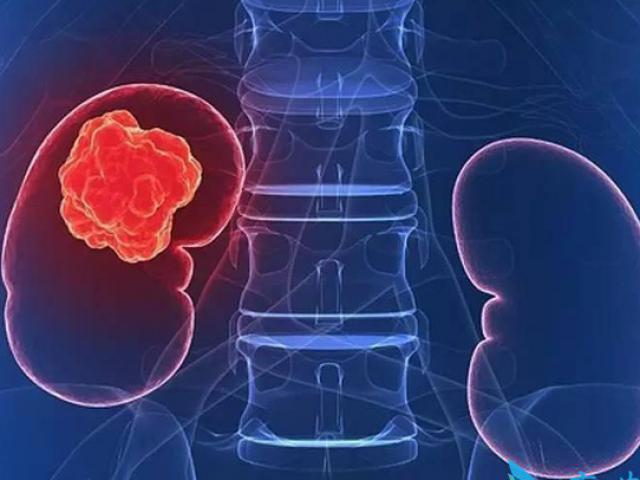 Nhận biết ung thư thận qua những dấu hiệu 'báo động' của cơ thể