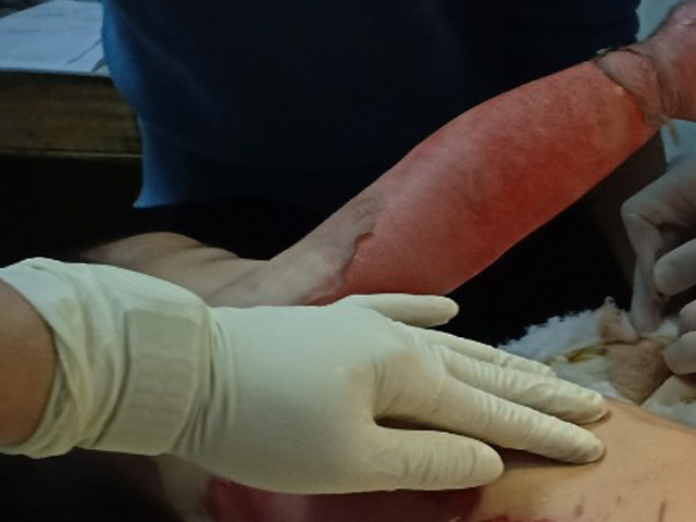 Bé 3 tuổi bị bỏng nặng, lột da toàn thân trong lúc chuẩn bị tắm