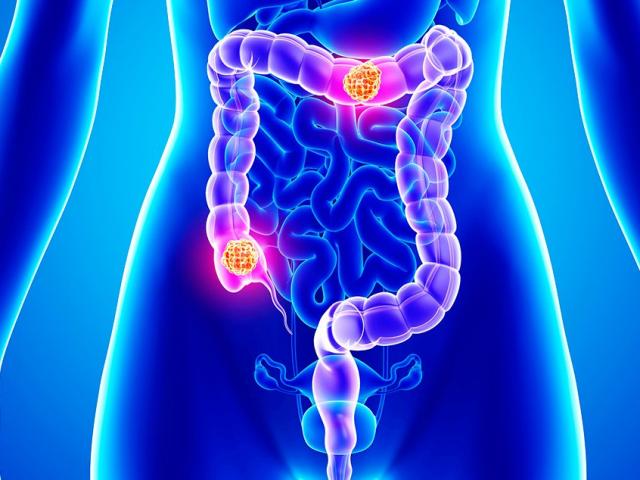 Ăn loại củ này, giảm 79% nguy cơ ung thư ruột