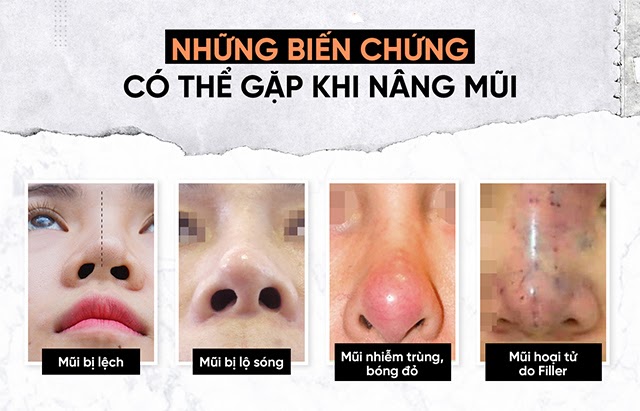 11 phương pháp nâng mũi phổ biến hiện nay - 13