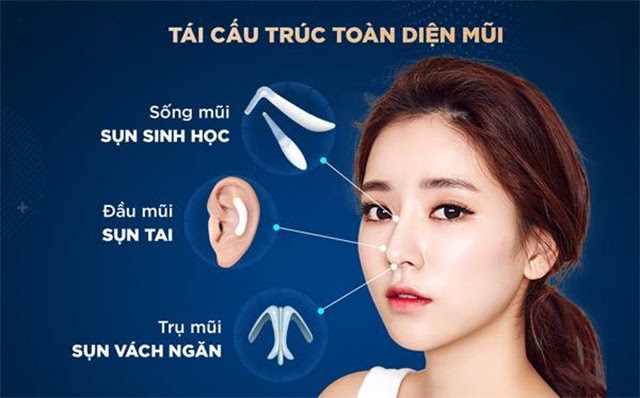 11 phương pháp nâng mũi phổ biến hiện nay - 9