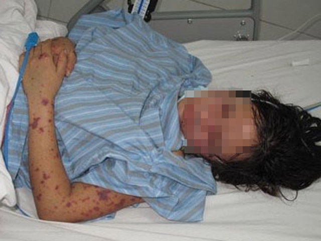 Cách ly thiếu nữ 15 tuổi ở Hà Nội bị virus “ăn não”, theo dõi 28 người Cách ly thiếu nữ 15 tuổi ở Hà Nội bị virus “ăn não”, theo dõi 28 người