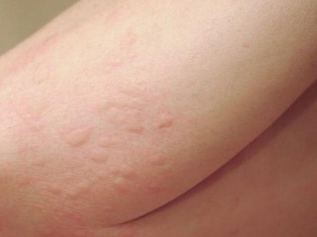 Dị ứng thức ăn có thể gây tử vong?