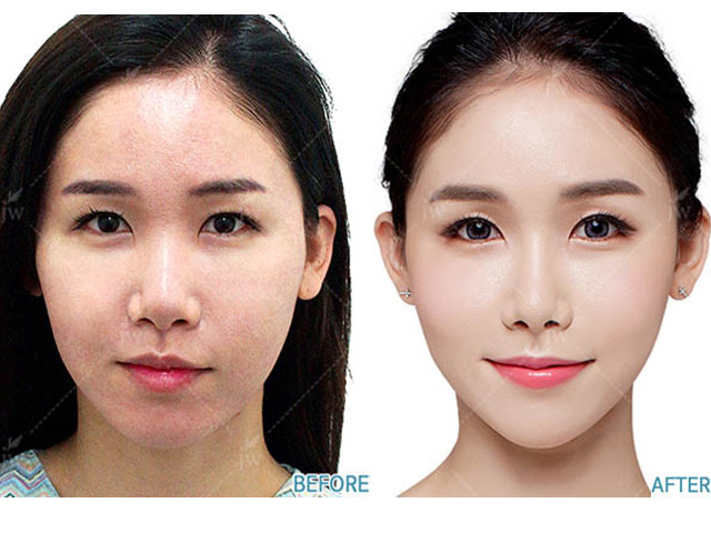 Cấy mỡ mặt Baby Face - xu hướng trẻ hóa gương mặt ưa chuộng 2018