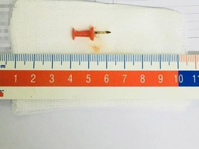 Nuốt phải đinh sắt dài 1,5 cm, bé 12 tuổi suýt chết
