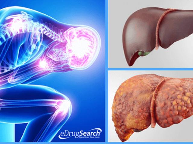 4 triệu chứng bệnh gan nhiễm mỡ không thể bỏ qua