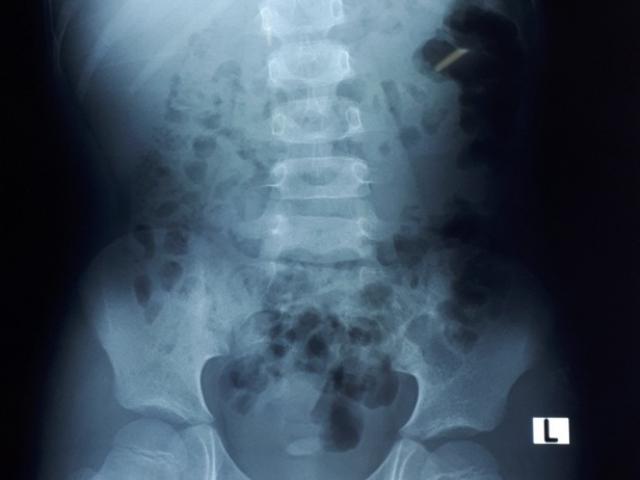 Mẹ “tá hỏa” khi bác sĩ phát hiện đầy sỏi trong thận của con trai 8 tuổi