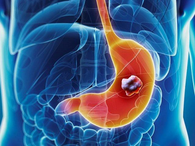 Người Việt dễ mắc ung thư dạ dày, cách nào phát hiện sớm?