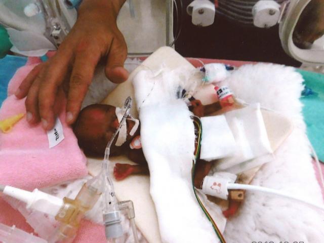 Sức sống mãnh liệt của cậu bé sinh non chỉ nặng bằng quả táo