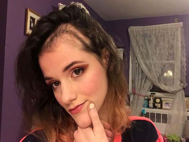 Căn bệnh lạ khiến cho cô gái không thể ngừng nhổ tóc 3 tiếng mỗi ngày