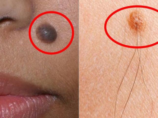 Nốt ruồi cứ có lông sẽ là ung thư?