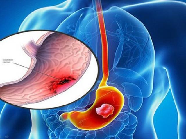 Thiếu nữ 18 tuổi đau bụng nhẹ đi khám phát hiện ung thư dạ dày giai đoạn cuối
