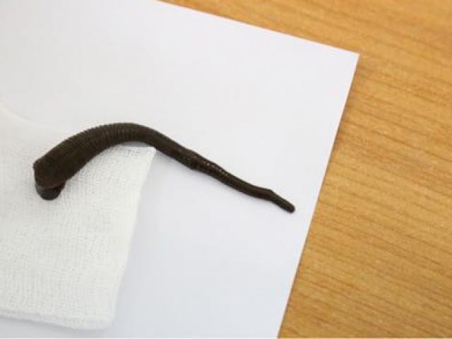 Hoảng hồn vì những con đỉa trốn kỹ trong cơ thể người tới mức bác sĩ khó tìm