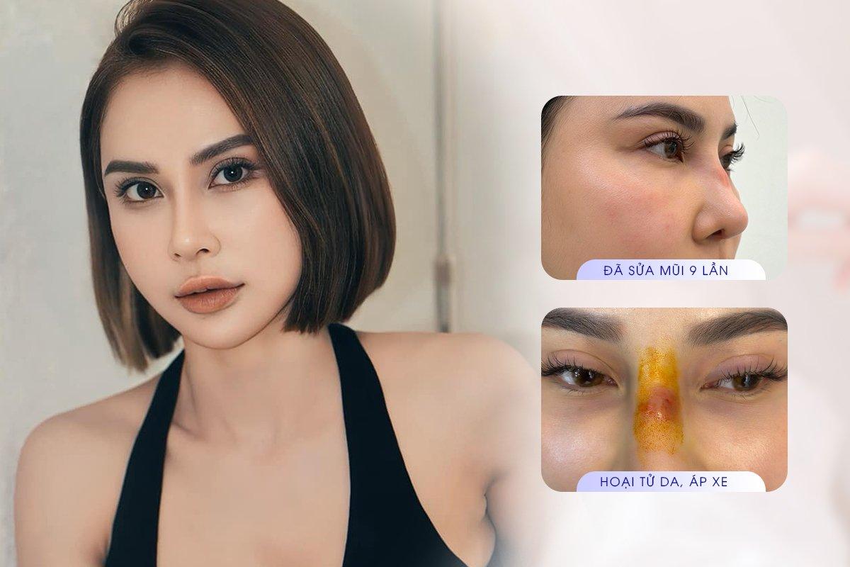 Sửa mũi trung bì cho KH sau 9 lần nâng mũi hỏng