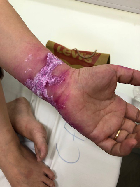 Lặn, "tông" vào sứa biển, du khách chằng chịt thương tích - 2