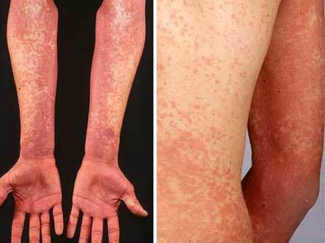 Nếu hay dùng thuốc Paracetamol, bạn nên đọc bài này