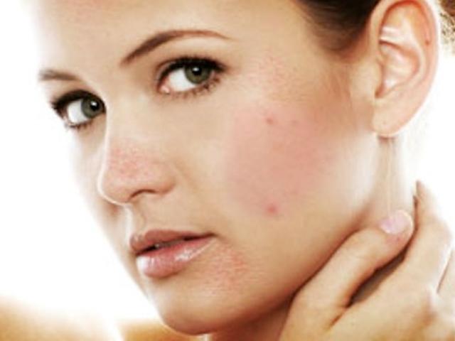 6 loại thuốc có thể gây mụn trứng cá