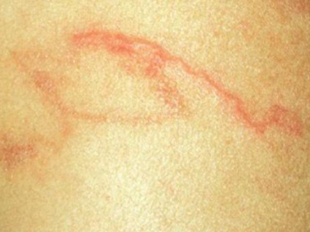 Chỉ chăm hoa mỗi ngày, một phụ nữ hoảng hồn khi ho ra sinh vật nhỏ xíu