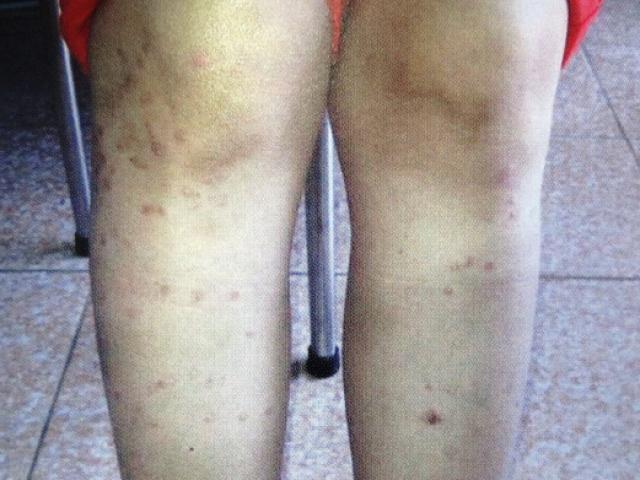 Tưởng nổi mụn lạ, cô gái khổ vì "bệnh siêu giả dạng"