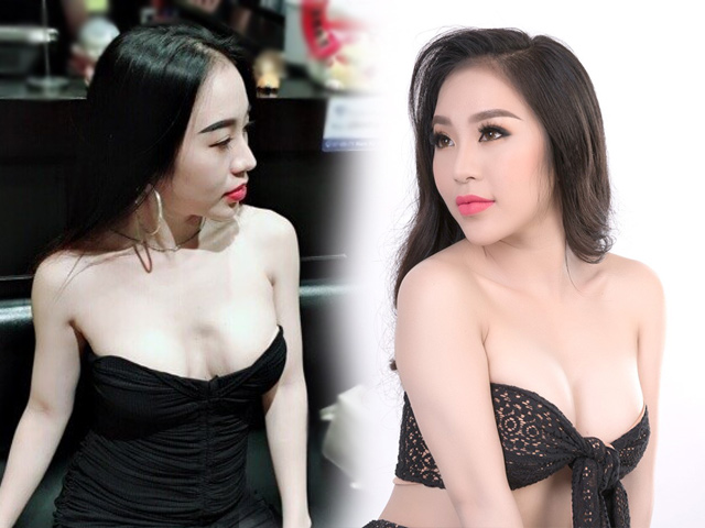 DJ Tuyết Nhung cứu bầu ngực bị lõm sau lần thẩm mỹ thứ 2