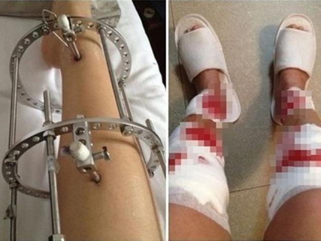 Hotgirl quyết nắn chân vòng kiềng vì mặc cảm