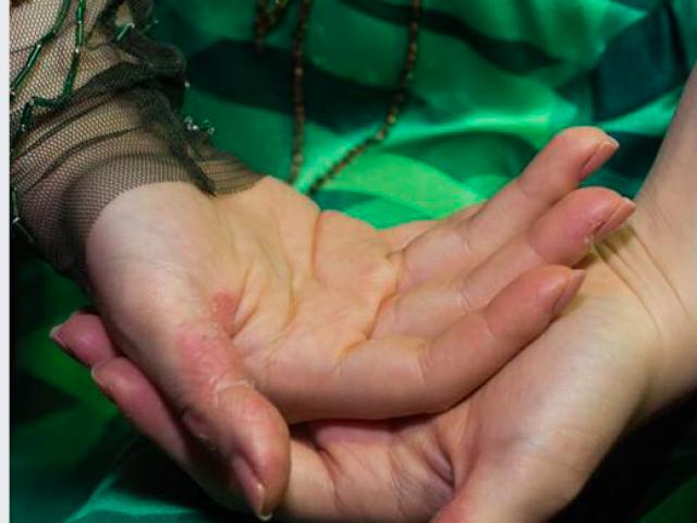 Ca sĩ Hương Tràm tự bóc da tay đến rỉ máu, cảnh báo nguy cơ bệnh gì?