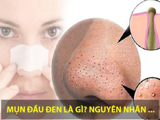 Cách trị mụn đầu đen tận gốc hiệu quả tại nhà từ nguyên liệu rẻ tiền